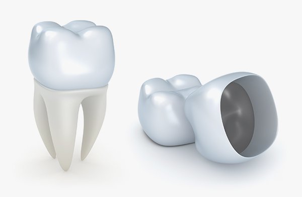 Do “Permanent” Crowns Last Forever?