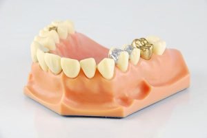 Castlemaine Smiles Dentist | Lost-Inlay-Onlay | Dentist Castlemaine