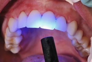 Dental Bonding | Dentist Castlemaine